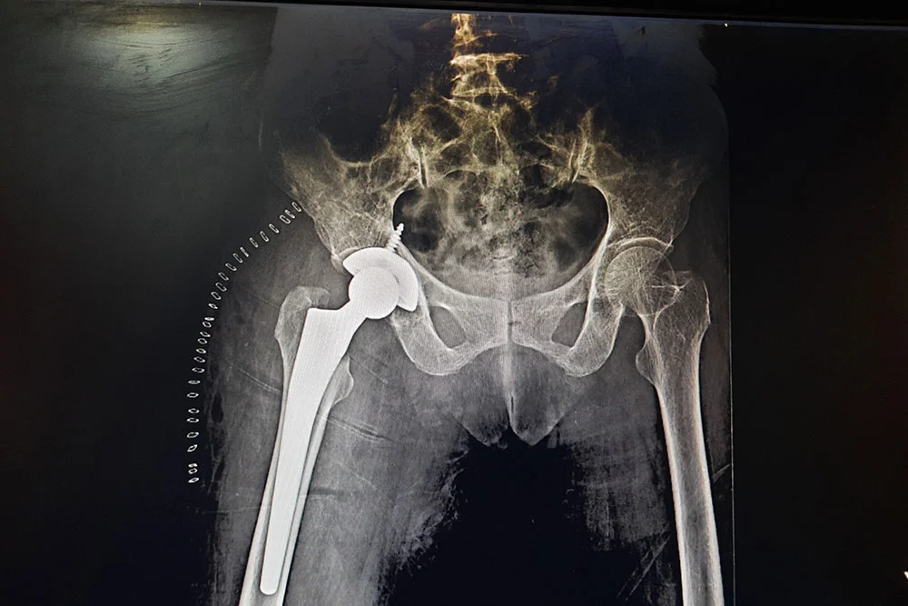 Joint Replacement Surgery Specialist Care at Viswanathan Hospital